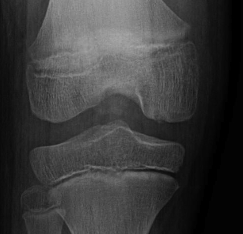 Femoral OCD